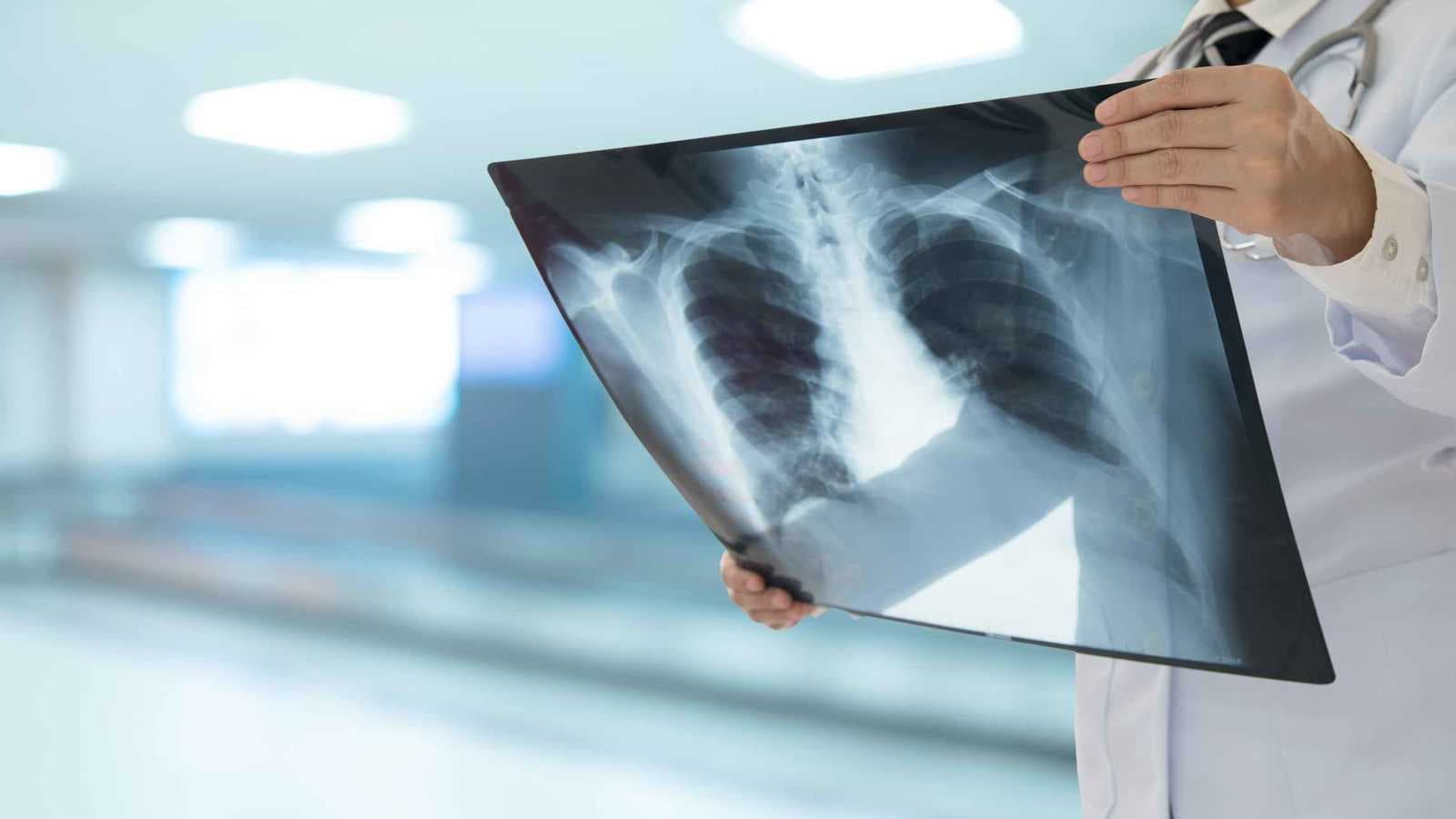 من الغذاء إلى الورم.. كيف يغذي السكر سرطان الرئة؟